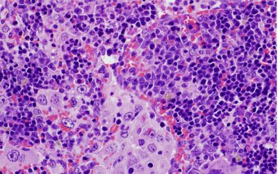 Un estudio del CSIC revela una mutación genética clave en la aparición de linfomas y el cáncer de pulmón