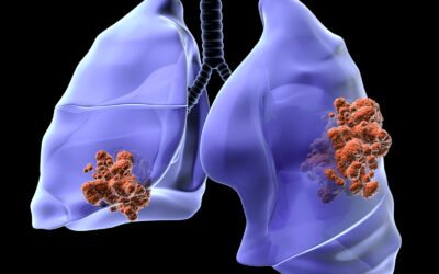 Describen por primera vez el potencial terapéutico de eliminar la proteína SOS1 del microentorno de tumores de pulmón