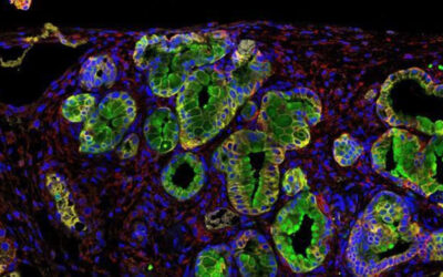 Una proteína antibacteriana, nueva diana terapéutica contra el cáncer de páncreas