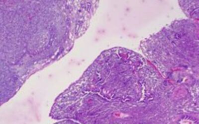 Demuestran la eficacia de un nuevo medicamento en una variación resistente de cáncer de pulmón