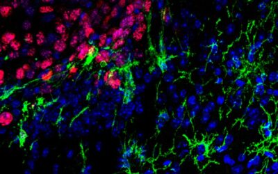 Descubren una nueva estrategia para combatir metástasis cerebrales del cáncer de piel más agresivo
